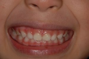 ガミースマイル