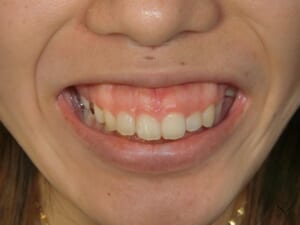 ガミーフェイス