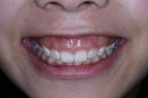 ガミーフェイス