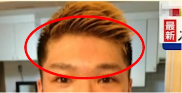 額・生え際の診断