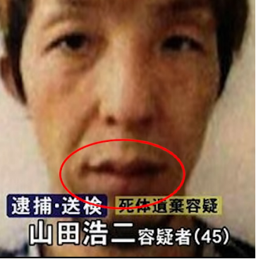 口・ほうれい線