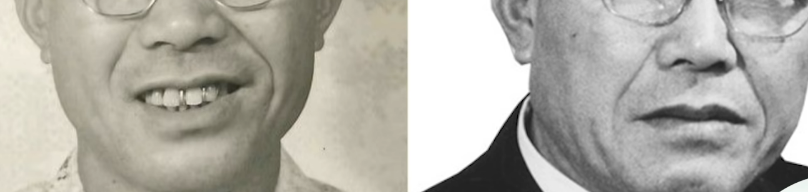 ほうれい線・口元