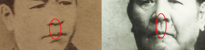 人中・ほうれい線