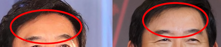額・生え際
